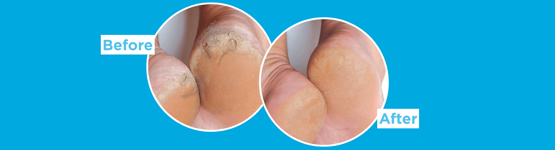 Side-by-side close-up comparison of a heel before and after use, showing dry, rough skin on the left and a smoother-looking heel on the right.