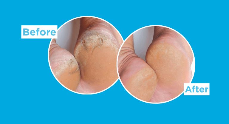 Side-by-side close-up comparison of a heel before and after use, showing dry, rough skin on the left and a smoother-looking heel on the right.
