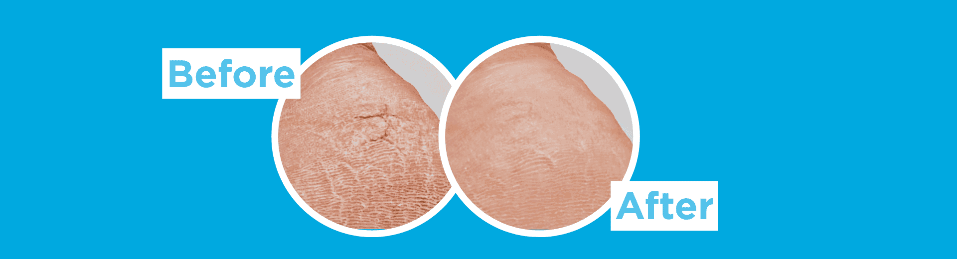 Desktop banner showing two circular close-up heel images on a blue background labeled “Before” and “After.” The left image shows dry, cracked heel skin, while the right image shows a smoother-looking heel in a before-and-after comparison.