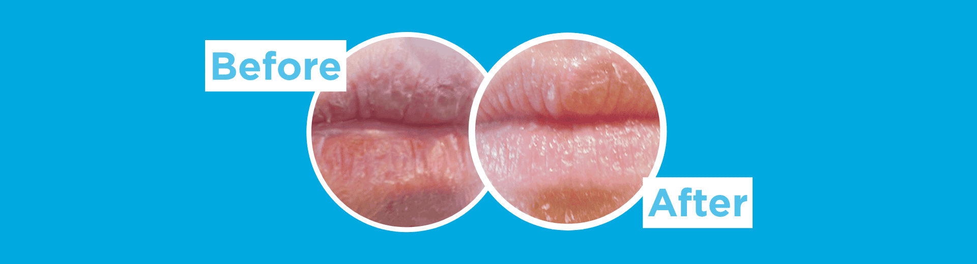 Side-by-side close-up comparison of lips in circular frames labeled Before and After on a blue background, showing dry-looking lips on the left and smoother-looking lips on the right.