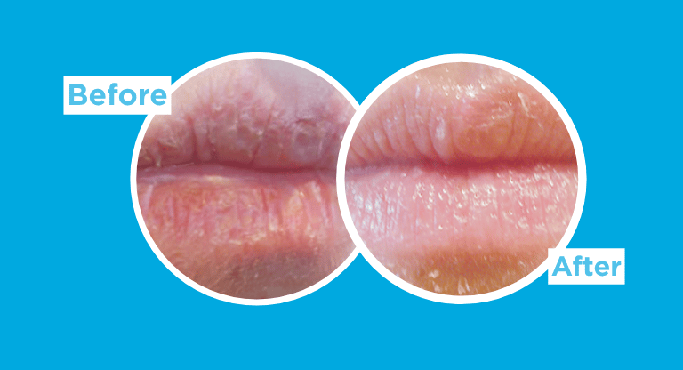 Side-by-side close-up comparison of lips in circular frames labeled Before and After on a blue background, showing dry-looking lips on the left and smoother-looking lips on the right.