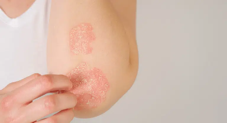 A close-up of a person's arm displaying a patch of psoriasis and fingers just about to scratch it.