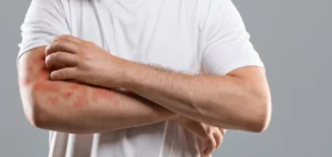 Person scratching a patch of eczema on their arm