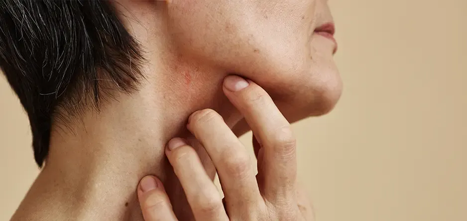 what is dermatillomania